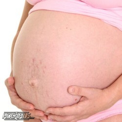 How do you avoid getting stretch marks while pregnant?