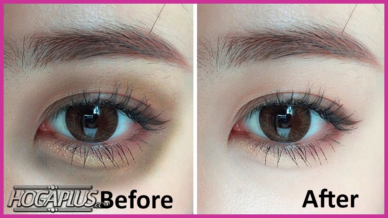 How to Get Rid of Dark Circles Under Eyes Fast & Permanently?