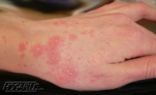 How to Get Rid of Scabies?
