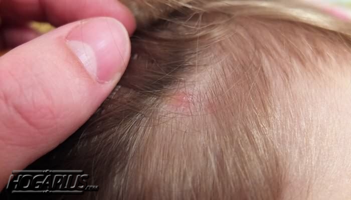 How to Get Rid of Scalp Acne?