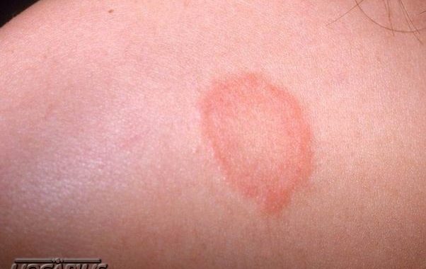 How to Get Rid of Skin Fungus?