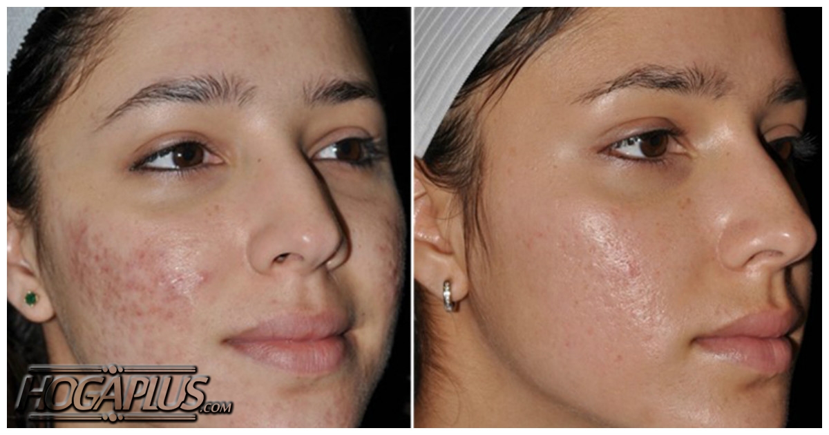 How to Heal Acne Fast and Naturally? 