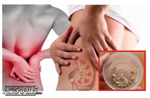 How to Prevent Kidney Stones?