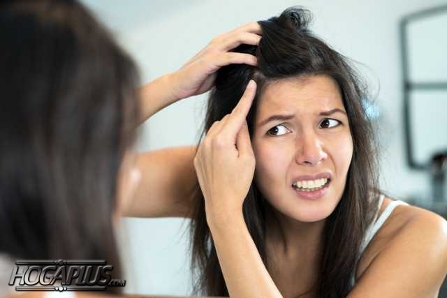 How to reduce dandruff naturally at home?
